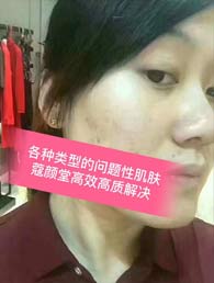暗疮痘痘祛除后